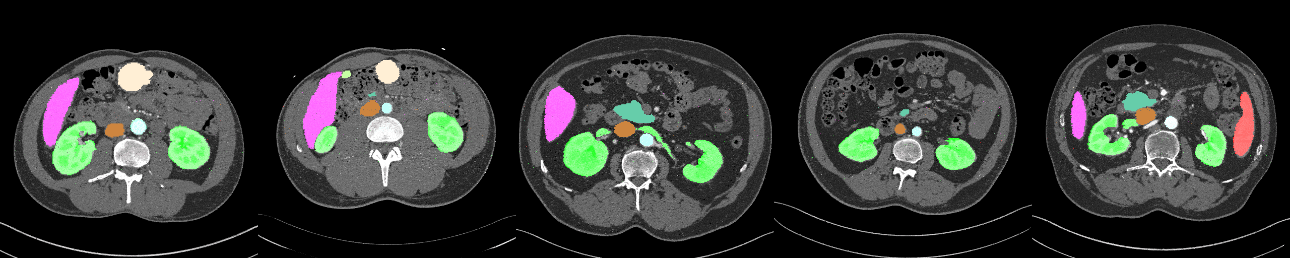 A GIF AbdomenAtlas-8K annotations as CT scans progress through five different abdomens. Annotations are colored on a black-and-white CT scan.